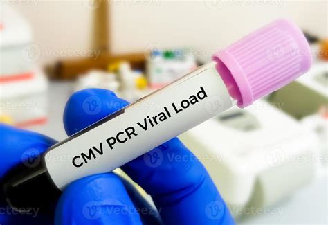 cmv pcr blood test bottle|cmv pcr.